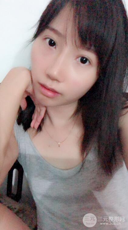 昆明華美美萊楊繼紅肋軟骨隆鼻前后對(duì)比圖恢復(fù)手札