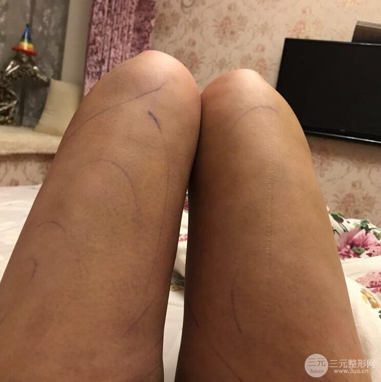 德陽東美奧克拉楊華博大腿吸脂前對對比圖 四個月恢復(fù)變化小記