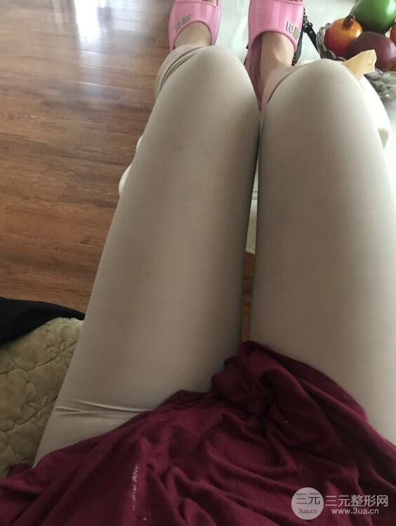 德陽東美奧克拉楊華博大腿吸脂前對對比圖 四個月恢復(fù)變化小記