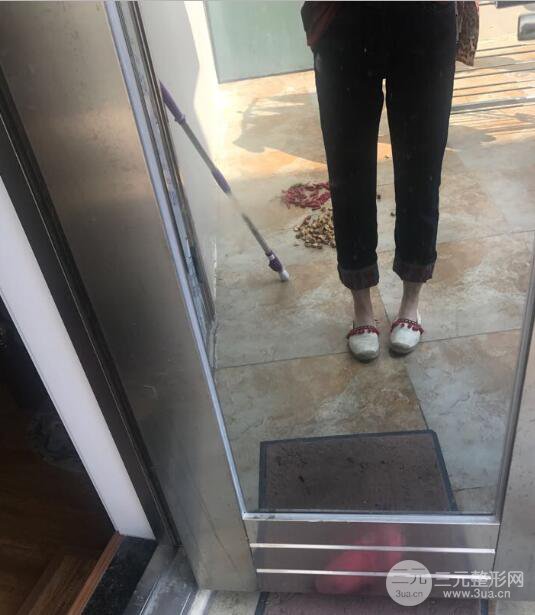 德陽東美奧克拉楊華博大腿吸脂前對對比圖 四個月恢復(fù)變化小記