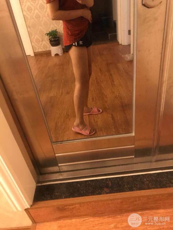 德陽東美奧克拉楊華博大腿吸脂前對對比圖 四個月恢復(fù)變化小記