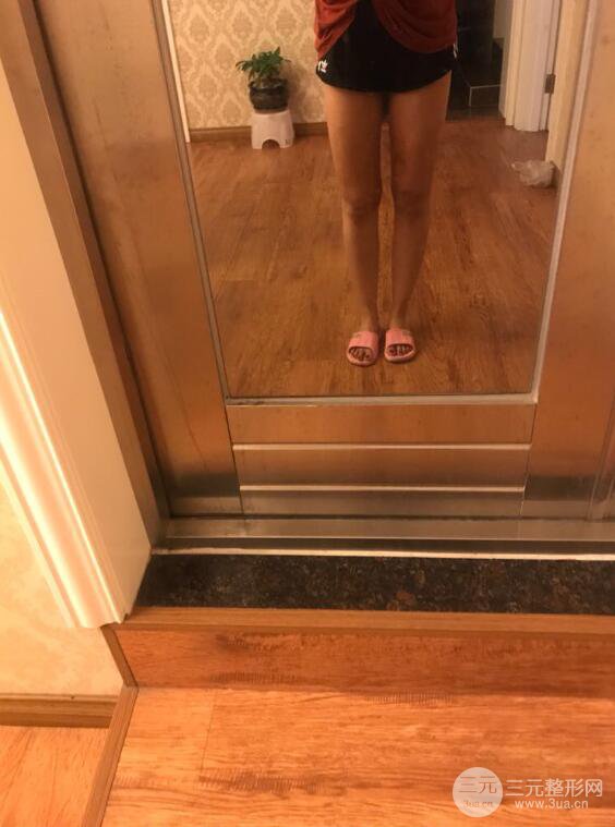 德陽東美奧克拉楊華博大腿吸脂前對對比圖 四個月恢復(fù)變化小記