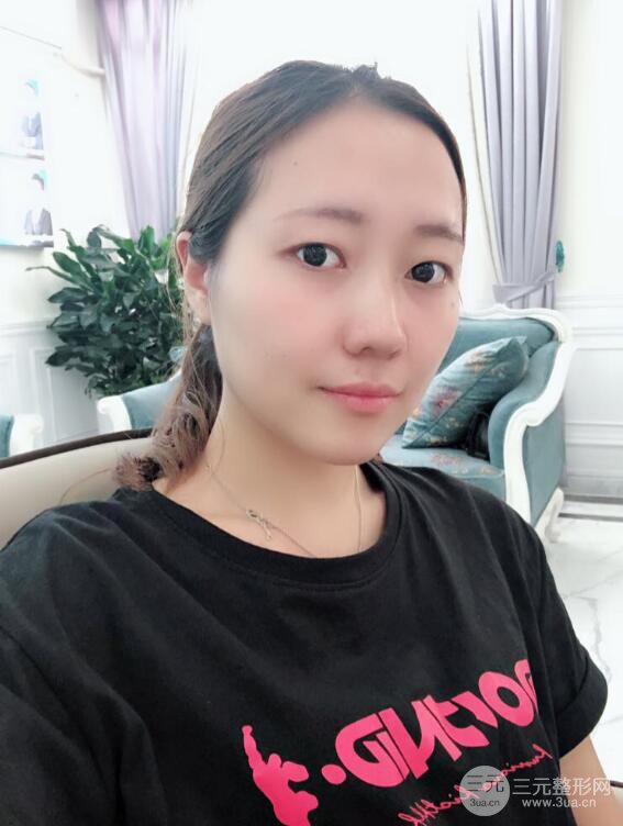 哈醫(yī)大二院整形科肖志波全切雙眼皮前后對(duì)比圖 真實(shí)恢復(fù)經(jīng)歷日記