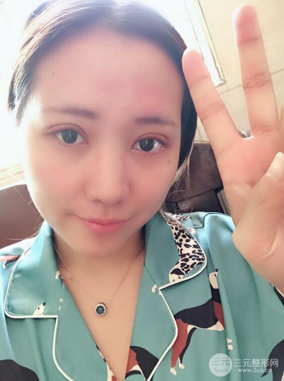 哈醫(yī)大二院整形科肖志波全切雙眼皮前后對(duì)比圖 真實(shí)恢復(fù)經(jīng)歷日記