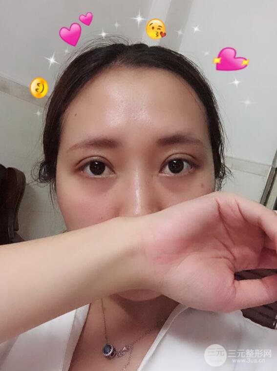 哈醫(yī)大二院整形科肖志波全切雙眼皮前后對(duì)比圖 真實(shí)恢復(fù)經(jīng)歷日記
