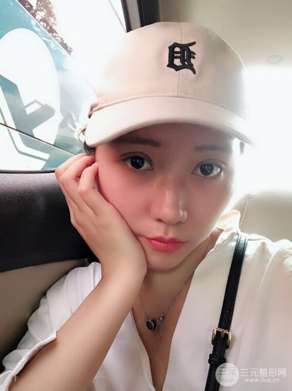 哈醫(yī)大二院整形科肖志波全切雙眼皮前后對(duì)比圖 真實(shí)恢復(fù)經(jīng)歷日記