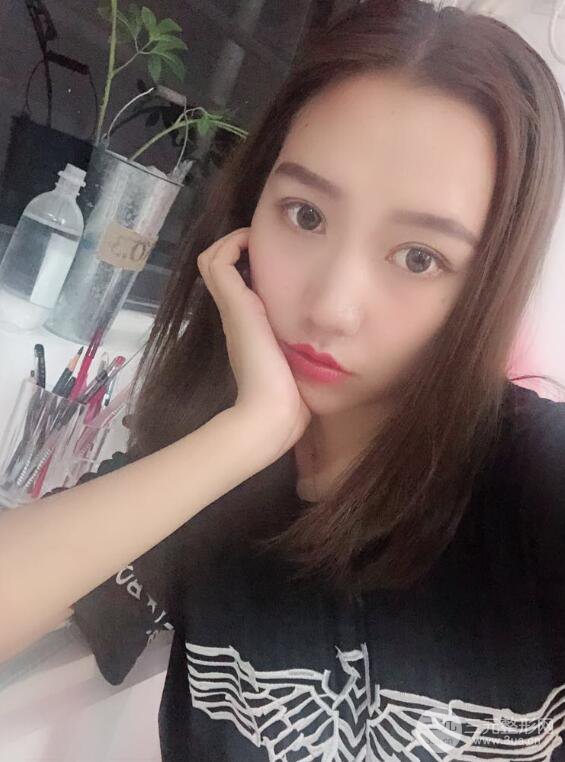 哈醫(yī)大二院整形科肖志波全切雙眼皮前后對(duì)比圖 真實(shí)恢復(fù)經(jīng)歷日記