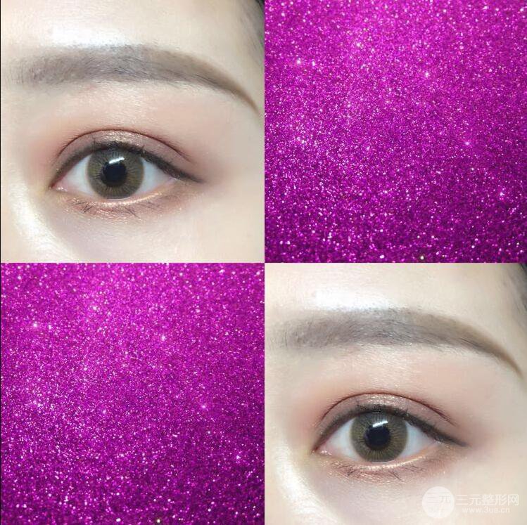 哈醫(yī)大二院整形科肖志波全切雙眼皮前后對(duì)比圖 真實(shí)恢復(fù)經(jīng)歷日記