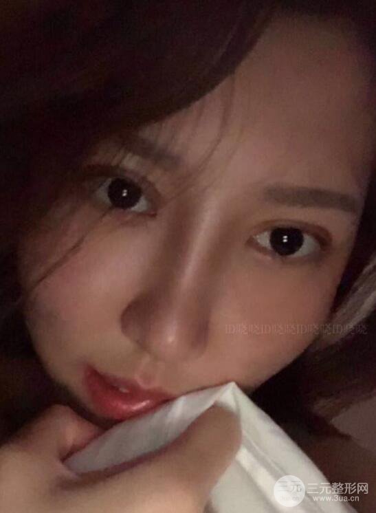松原齊飛隆鼻整形+雙眼皮一個月前后對比圖真人案例小札