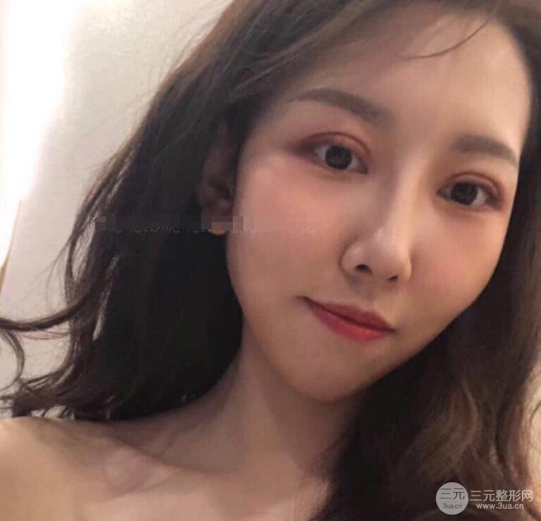 松原齊飛隆鼻整形+雙眼皮一個月前后對比圖真人案例小札