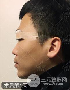 歐陽春雙眼皮前后對比圖 男孩子割雙眼皮一樣好看