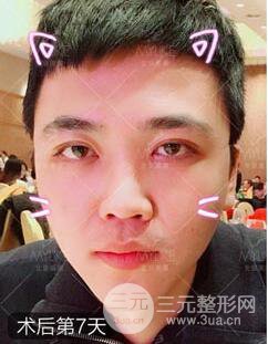 歐陽春雙眼皮前后對比圖 男孩子割雙眼皮一樣好看