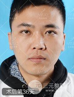 歐陽春雙眼皮前后對比圖 男孩子割雙眼皮一樣好看