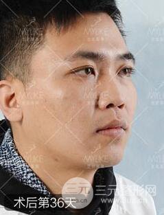 歐陽春雙眼皮前后對比圖 男孩子割雙眼皮一樣好看