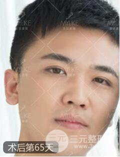 歐陽春雙眼皮前后對比圖 男孩子割雙眼皮一樣好看