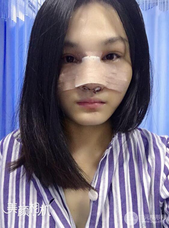 上海薇琳顧陸健韓式隆鼻前后對比圖|真人案例心情日記