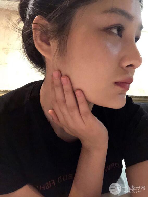 上海薇琳顧陸健韓式隆鼻前后對比圖|真人案例心情日記