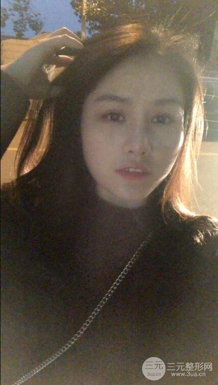 上海薇琳顧陸健韓式隆鼻前后對比圖|真人案例心情日記