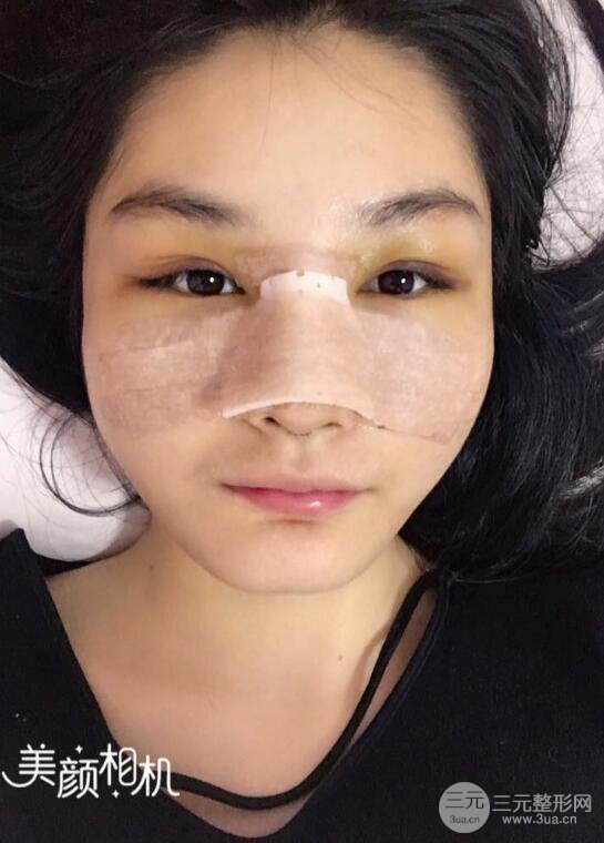 上海薇琳顧陸健韓式隆鼻前后對比圖|真人案例心情日記