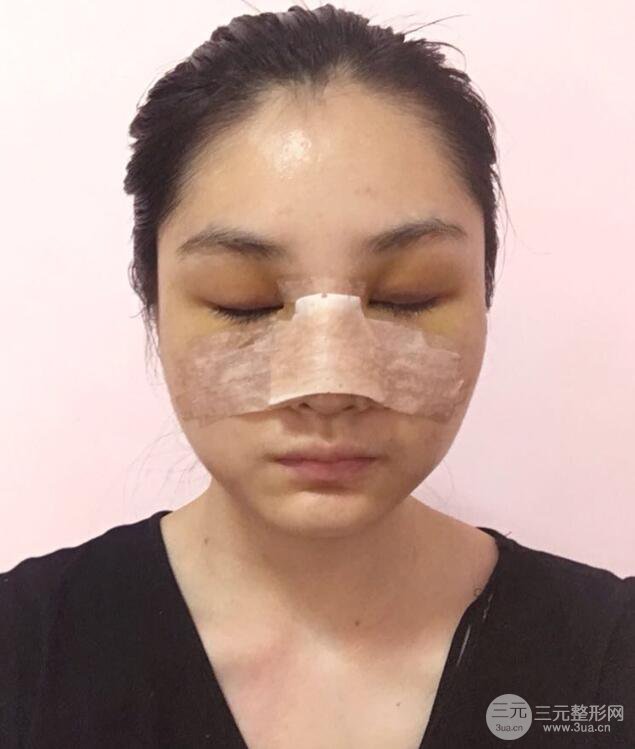 上海薇琳顧陸健韓式隆鼻前后對比圖|真人案例心情日記