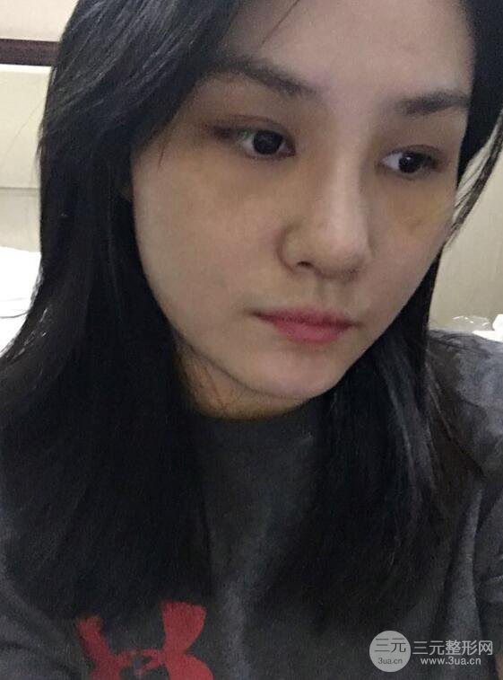 上海薇琳顧陸健韓式隆鼻前后對比圖|真人案例心情日記