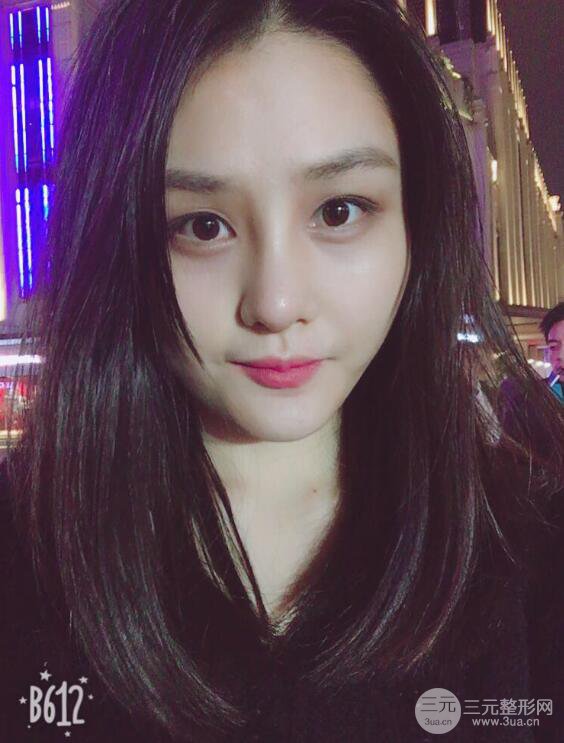 上海薇琳顧陸健韓式隆鼻前后對比圖|真人案例心情日記