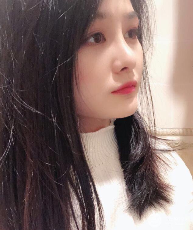 上海薇琳顧陸健韓式隆鼻前后對比圖|真人案例心情日記