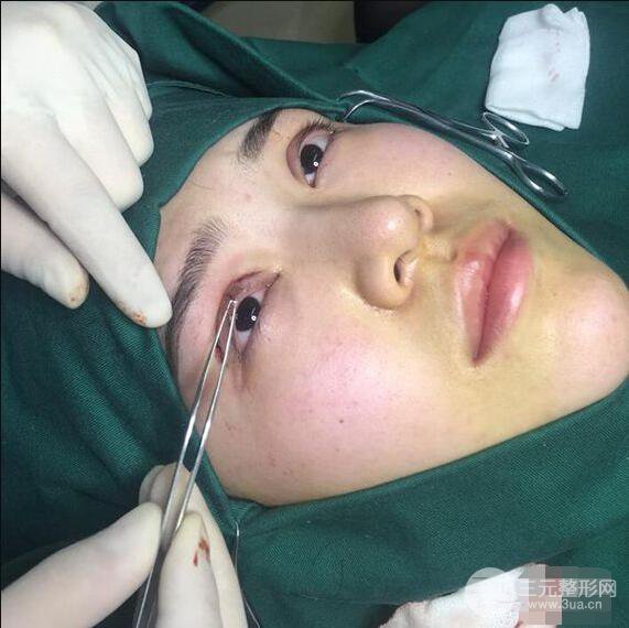 延吉金光善眼部整形失敗修復(fù)前后對比圖 三個月恢復(fù)自然