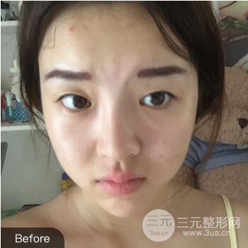 成都天使之翼張勁松切開雙眼皮案例前后對(duì)比圖心情小札
