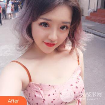 成都天使之翼張勁松切開雙眼皮案例前后對(duì)比圖心情小札