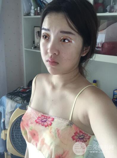 成都天使之翼張勁松切開雙眼皮案例前后對(duì)比圖心情小札
