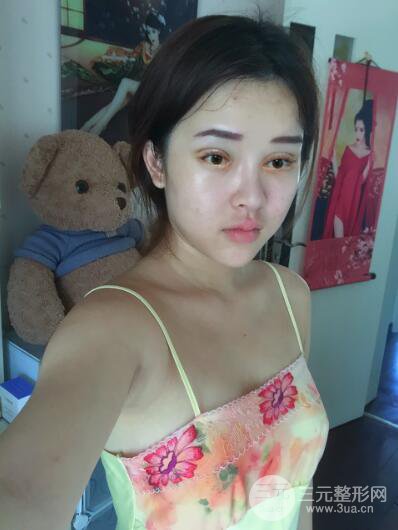 成都天使之翼張勁松切開雙眼皮案例前后對(duì)比圖心情小札