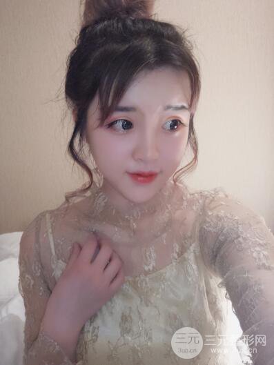 成都天使之翼張勁松切開雙眼皮案例前后對(duì)比圖心情小札