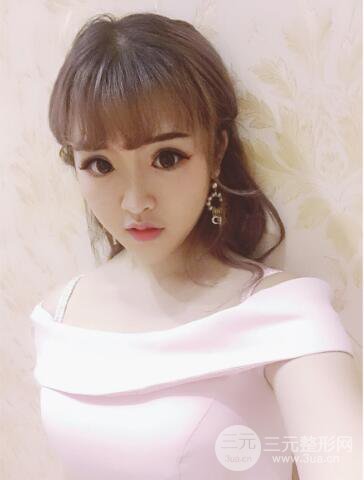 成都天使之翼張勁松切開雙眼皮案例前后對(duì)比圖心情小札