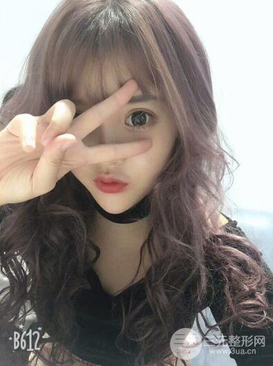 成都天使之翼張勁松切開雙眼皮案例前后對(duì)比圖心情小札