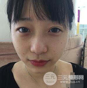 杭州華山連天美高俊明雙眼皮案例前后對(duì)比圖心情分享