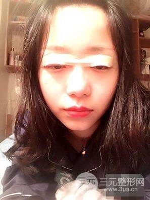 杭州華山連天美高俊明雙眼皮案例前后對(duì)比圖心情分享