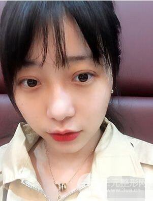 杭州華山連天美高俊明雙眼皮案例前后對(duì)比圖心情分享