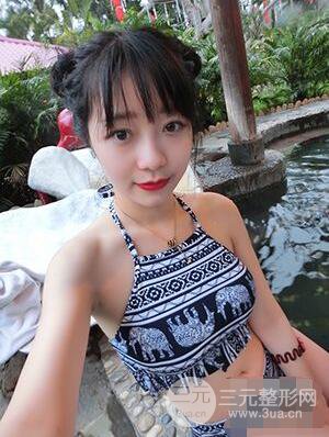 杭州華山連天美高俊明雙眼皮案例前后對(duì)比圖心情分享