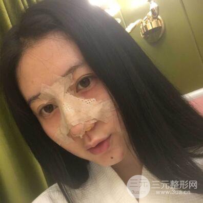 合肥壹加壹王大勇假體隆鼻果對(duì)比圖 45天恢復(fù)心路歷程