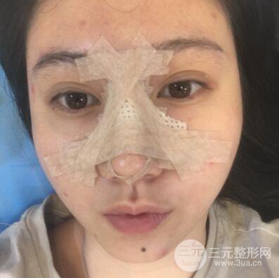 合肥壹加壹王大勇假體隆鼻果對(duì)比圖 45天恢復(fù)心路歷程