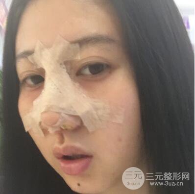 合肥壹加壹王大勇假體隆鼻果對(duì)比圖 45天恢復(fù)心路歷程