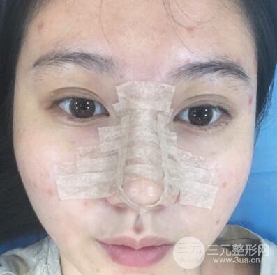 合肥壹加壹王大勇假體隆鼻果對(duì)比圖 45天恢復(fù)心路歷程