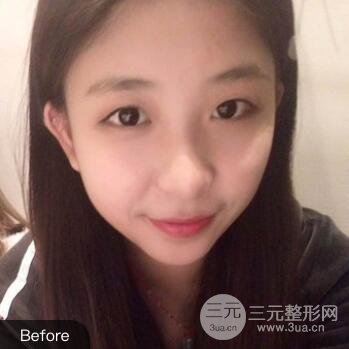 沈陽軍區(qū)總醫(yī)院時杰切開雙眼皮案例對比圖|內(nèi)附心情恢復(fù)小札哦