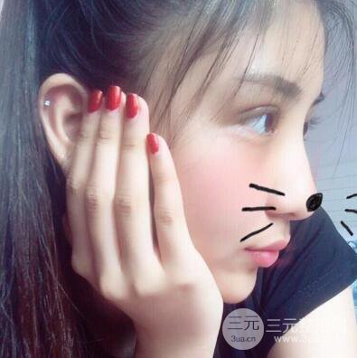 沈陽軍區(qū)總醫(yī)院時杰切開雙眼皮案例對比圖|內(nèi)附心情恢復(fù)小札哦