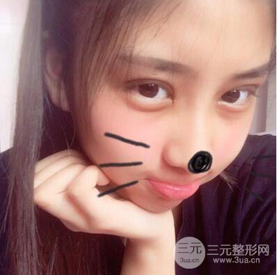 沈陽軍區(qū)總醫(yī)院時杰切開雙眼皮案例對比圖|內(nèi)附心情恢復(fù)小札哦