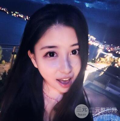 沈陽軍區(qū)總醫(yī)院時杰切開雙眼皮案例對比圖|內(nèi)附心情恢復(fù)小札哦