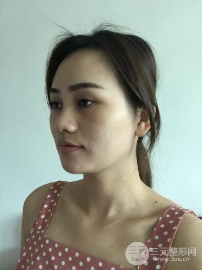 松原齊飛整形割雙眼皮真人案例前后對(duì)比圖日扎分享