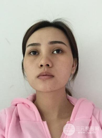 松原齊飛整形割雙眼皮真人案例前后對(duì)比圖日扎分享