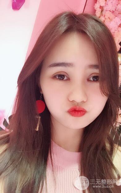 松原齊飛整形割雙眼皮真人案例前后對(duì)比圖日扎分享